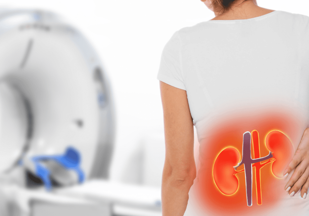 means of treating kidney stones