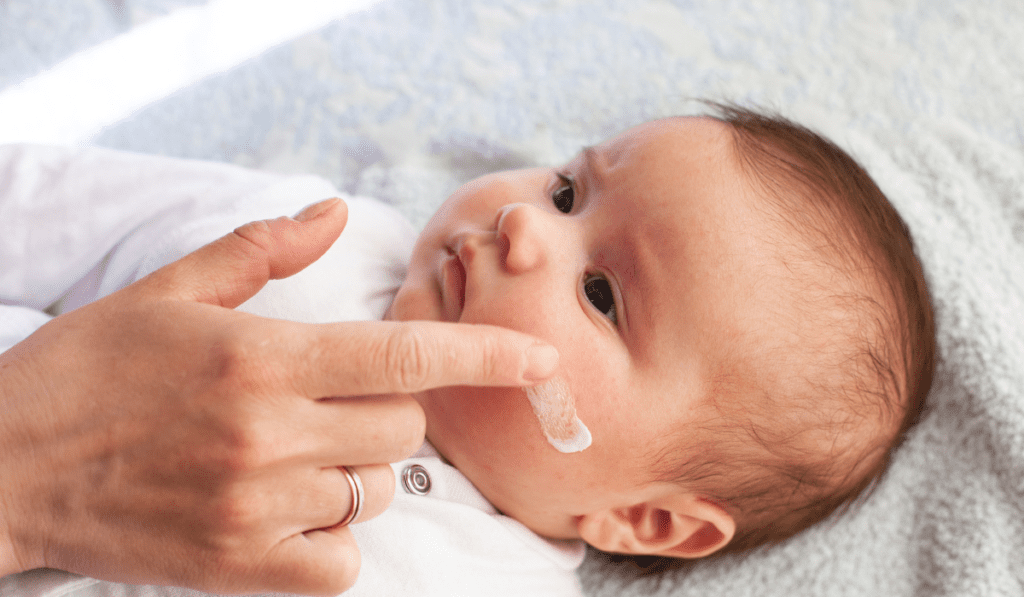 Natural Remedies for Baby Eczema; Ways to help treat baby eczema