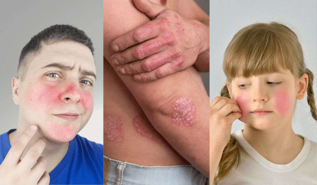 Reduce Skin Redness and Inflammation: Effective Tips for Quick Relief from Eczema Symptoms; Symptoms and Types of Eczema