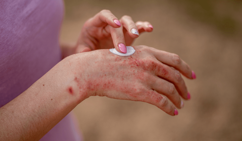 Reduce Skin Redness and Inflammation: Effective Tips for Quick Relief from Eczema Symptoms; Tips for Quick Relief