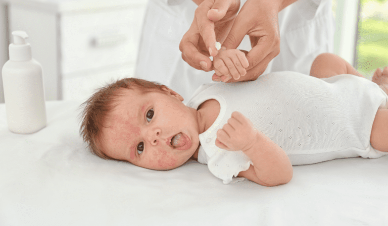 Natural Remedies for Baby Eczema