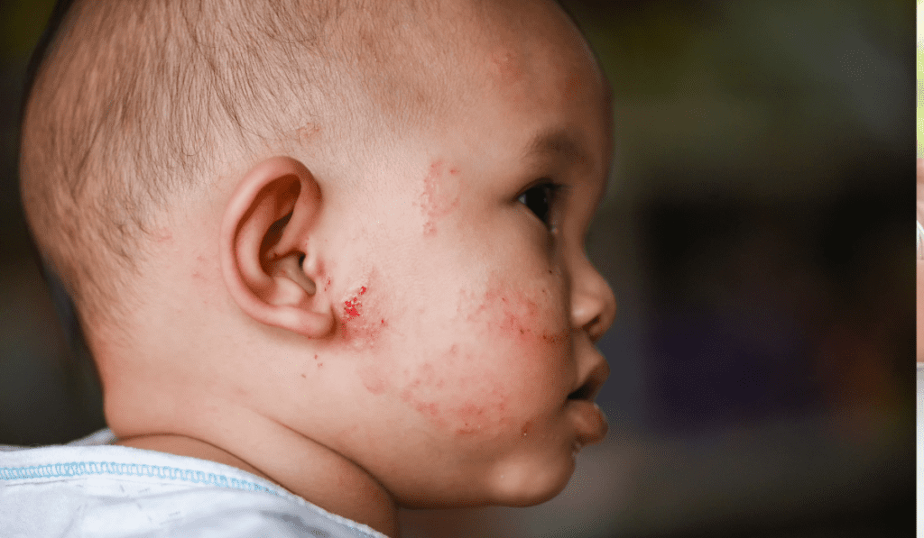 Eczema Symptoms: How To Tell If Your Baby Has Eczema; Symptom # 1- Small, red skin bumps