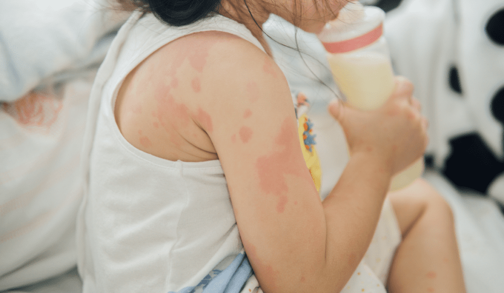 Natural Treatment for Eczema - The Healing Enzymes