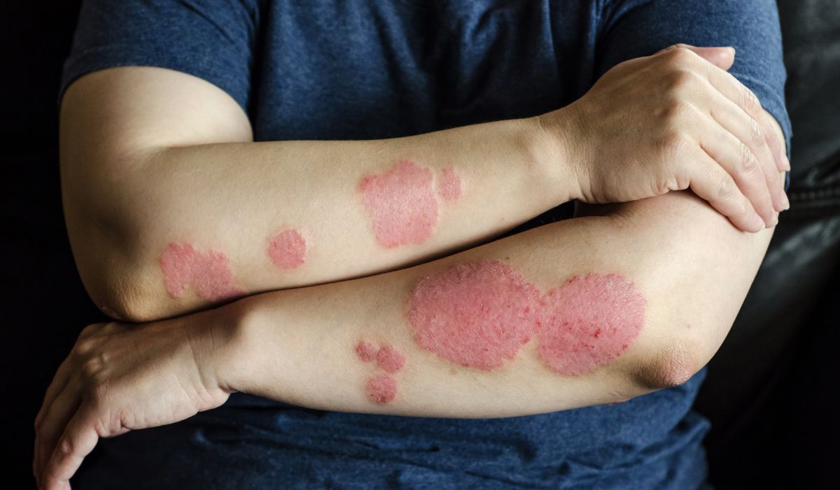 Most Common Causes Of Dermatitis